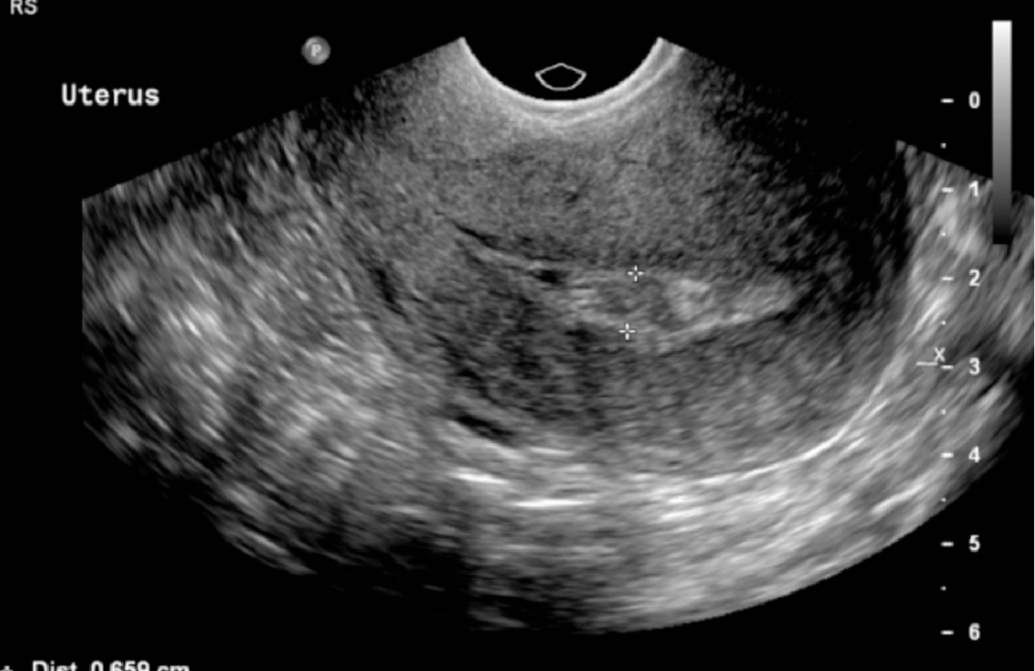 Obstetrical USG, BPP