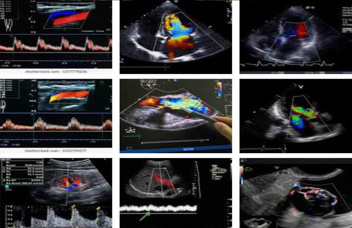 Color-Doppler